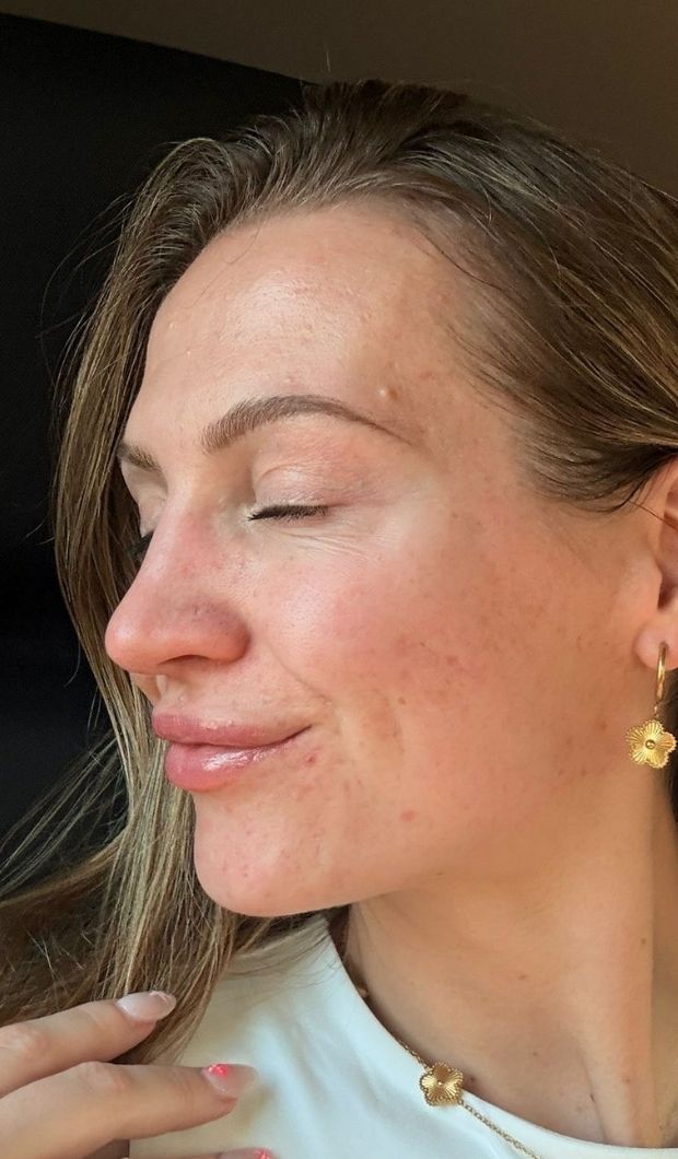 Erin later in her six-month skin journey