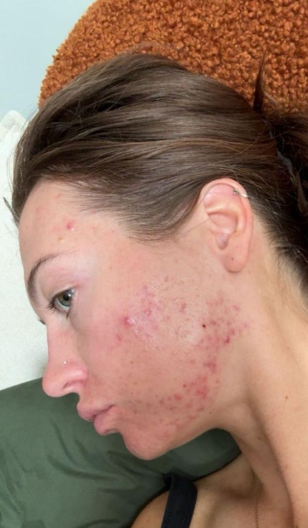 Erin at the start of her skin journey, with visible breakouts