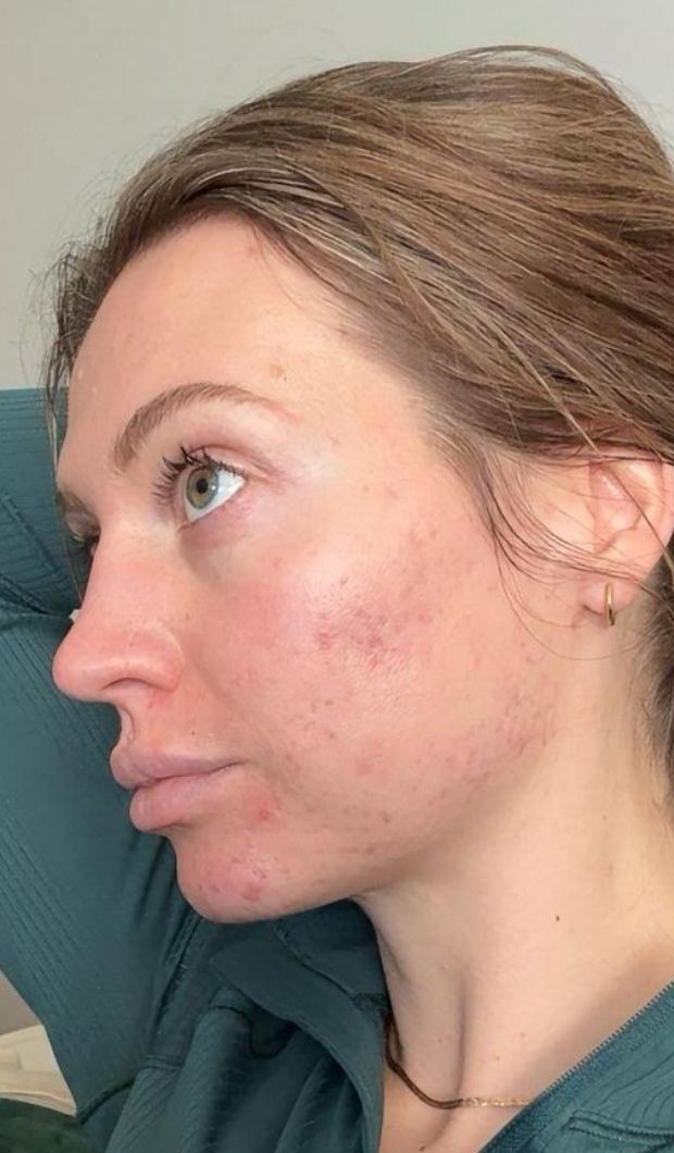 Erin’s skin: a new chapter
